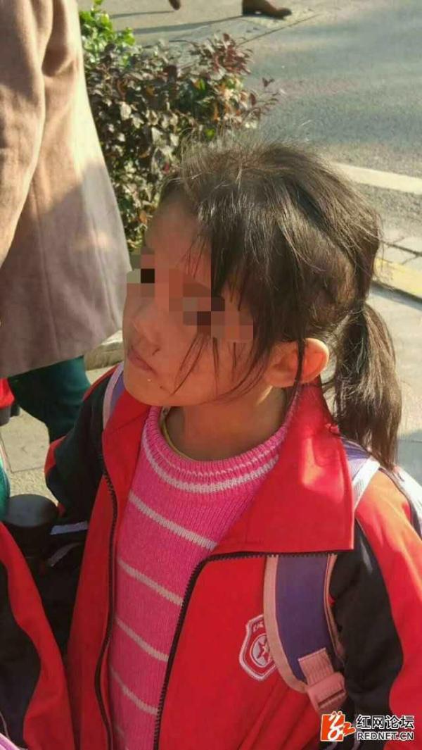 长沙6岁女童疑遭虐待满身伤痕头骨凹凸 其母被刑拘